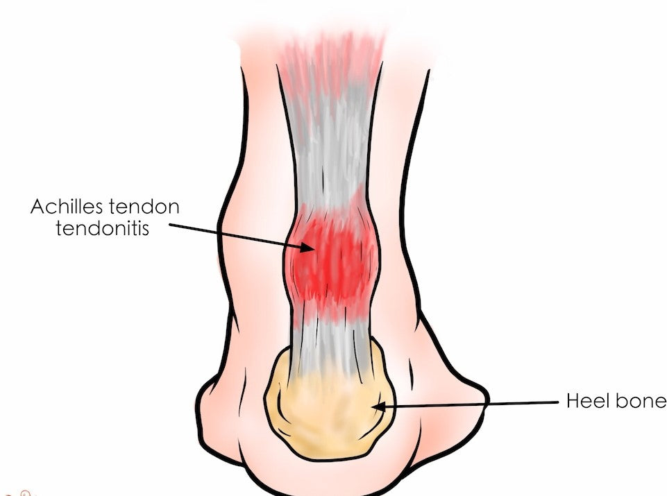 Rolling Away the Pain: Using a Foam Roller for Achilles Tendonitis Relief