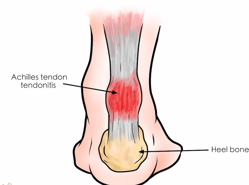 Rolling Away the Pain Using a Foam Roller for Achilles Tendonitis Rel