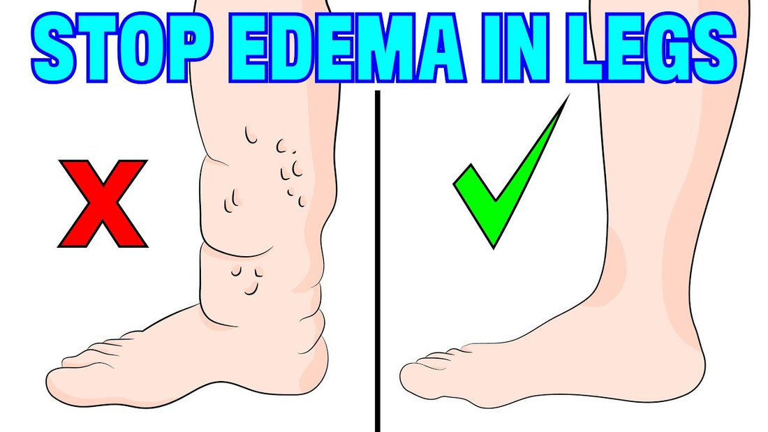 Edema and Lymphedema swelling in legs and feet can be painful but Rollga can help by improving lymphatic drainage thru self-massage