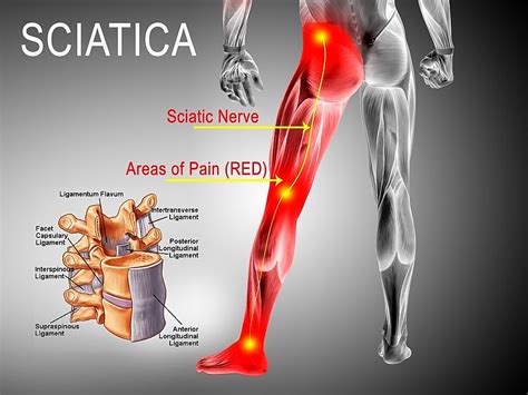 Sciatica Treatment: Effective Strategies and the Role of Rollga Foam Rollers
