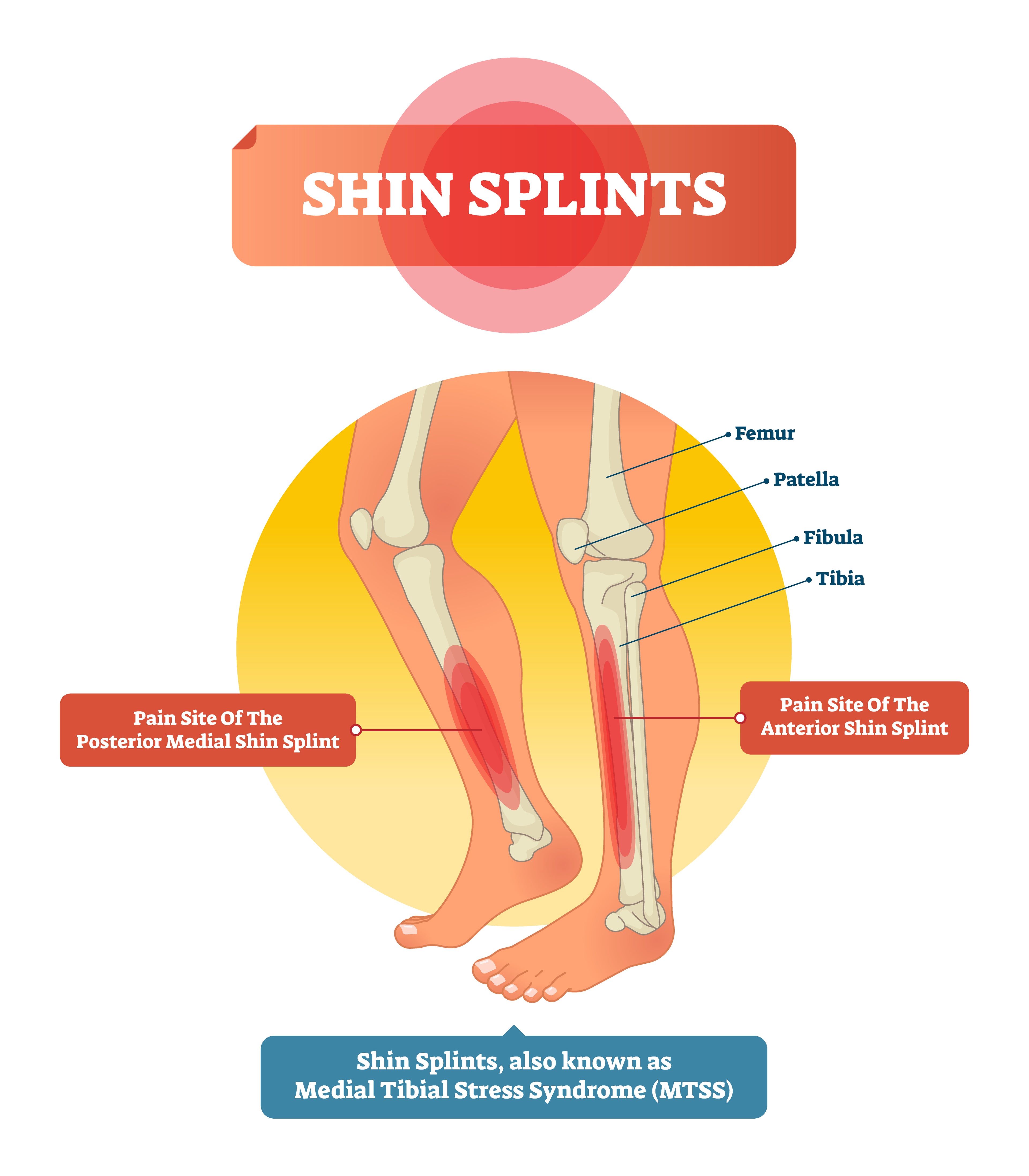Shin splints can be a real pain—literally! If you're an active individual, whether you're a runner, athlete, or just enjoy brisk walks, you might have experienced the discomfort of shin splints at some point