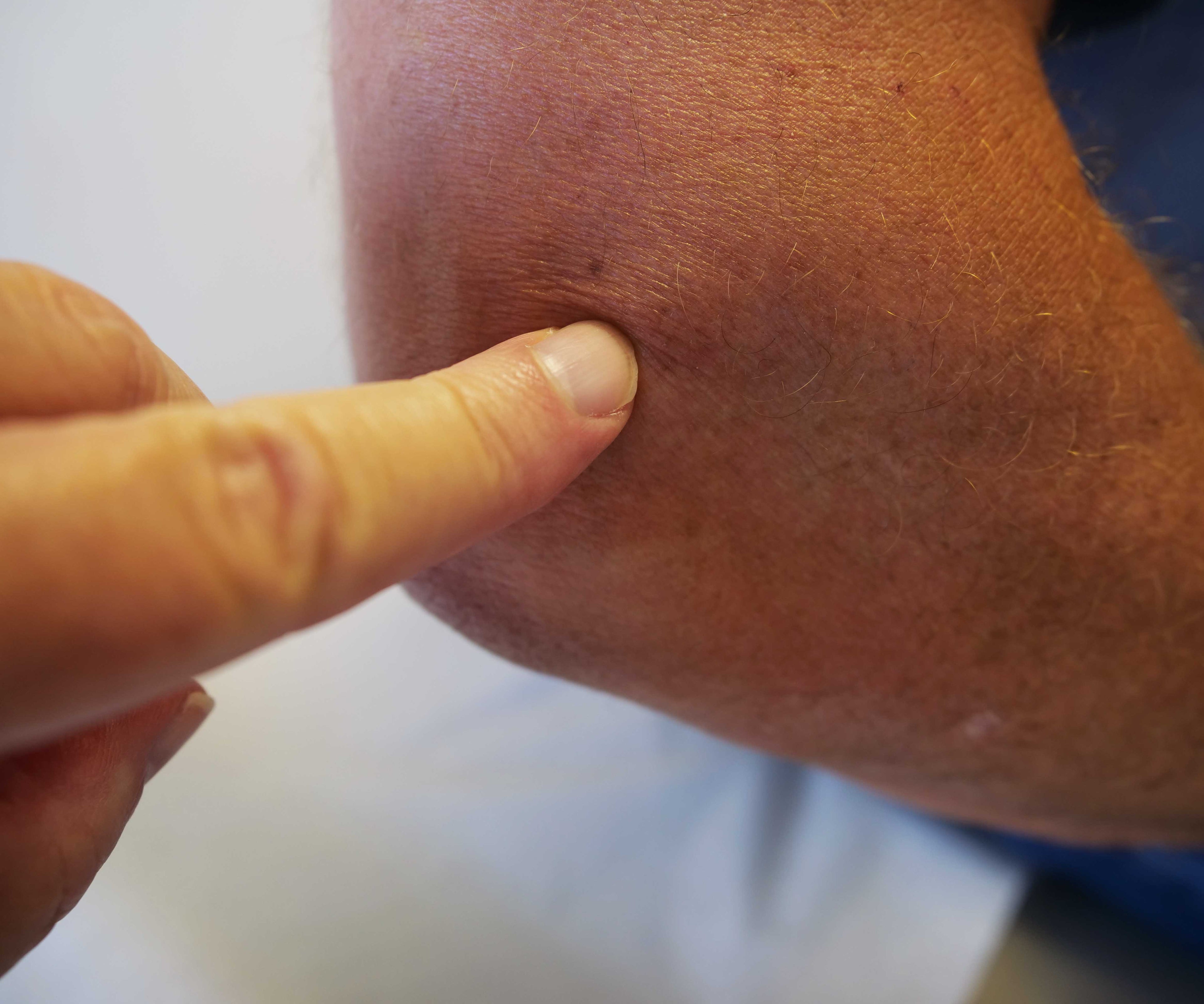 4 Steps to Alleviating Tennis Elbow Pain